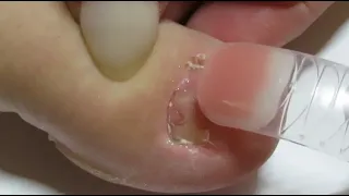 Toenail Transformation Using  (Dual Forms ) Polygel / Natural Builder Gel AMAZING Transformation