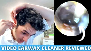 Ear Specialist Reviews Home Ear Wax Removal Camera (Bebird Earokay Ear Cleaner)