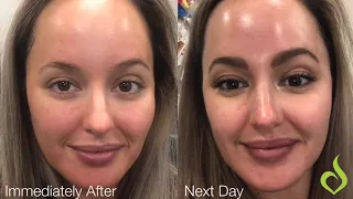 Achieving Perfect Skin with VI Precision Plus Peel