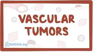 Vascular tumors (kaposi, hemangioma, angiosarcoma) - causes & symptoms