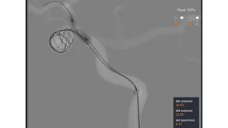 Mentice Neurovascular Brain Aneurysm Coiling Demo