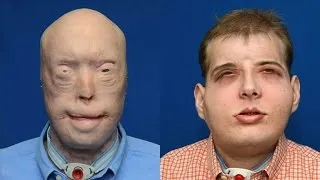 US team carries out most complex face transplant