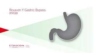 Roux-en-Y Gastric Bypass (RYGB) Animation Explainer Video