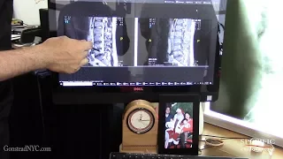 Slipped disc with severe sciatica, no surgery FIXED by Dr Suh Gonstead Chiropractor