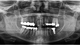 Guess the unknown structure in panoramic radiograph