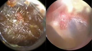 133 - Extremely Blocked & Impacted Ear Wax Removal using WAXscope®️