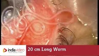 20 cm Long Worm In The Human Eye, First Ever Recorded On Video | India Video