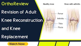 OrthoReview - Revision of Adult Knee Reconstruction and Knee Replacement for Orthopaedic Exams
