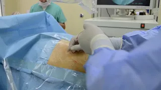 Perkutan nefrolitotripsiya - Op.Dr Anar Almazxanli