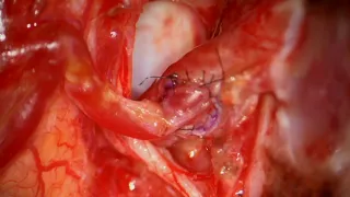 Far Lateral Craniotomy for Excision and Reimplantation of a Ruptured PICA Aneurysm