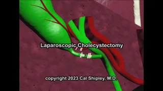 Cholecystectomy by Cal Shipley, M.D.