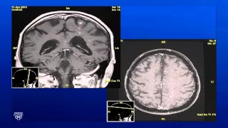 Unilateral Panuveitis