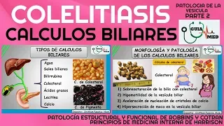 CÁLCULOS BILIARES (FISIOPATOLOGÍA PARTE 2) | GuiaMed