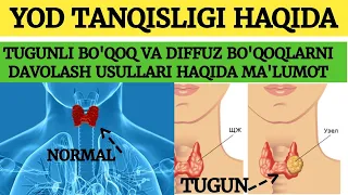 TUGUNLI BO'QOQNI DAVOLASH HAQIDA MA'LUMOT. YOD TANQISLIGI HAQIDA MA'LUMOT. #TUGUNLI BO'QOQ