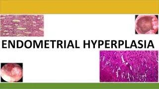 Endometrial Hyperplasia,  Brief Discussion on RCOG Guideline