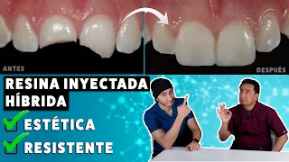 Carillas de Resina Inyectada Híbridas ¡Estéticas pero Resistentes! | Una excelente alternativa