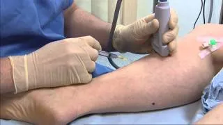 Foam sclerotherapy for varicose veins - Philip Coleridge Smith