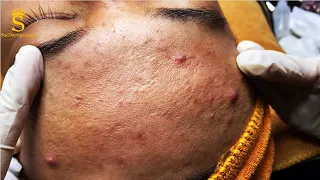 Acne Treatment Never Easy | Điều Trị Mụn Trứng Cá Chưa Bao Giờ là Dễ Dàng - SacDepSpa#108