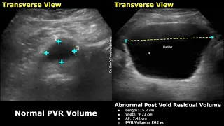 Pre Void & Post Void Residual Volume Bladder Ultrasound Normal Vs Abnormal Images | PVR USG