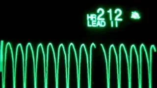 Pulseless Ventricular Tachycardia (pVT)