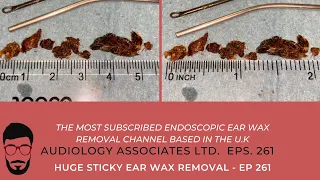 HUGE STICKY EAR WAX REMOVAL - EP 261