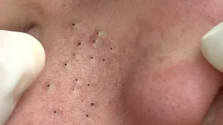 Suri Job #579: Awesome Blackheads Extraction in Young Lady