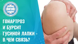 🤷‍♂️ 🦵 Гонартроз и бурсит гусиной лапки - в чем связь?