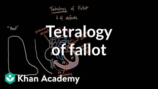 Tetralogy of fallot | Circulatory System and Disease | NCLEX-RN | Khan Academy