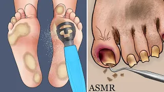 ASMR Climbers plantar calluses and rot toenails care animation
