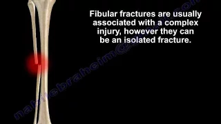 Fibular Fracture ,isolated- Everything You Need To Know - Dr. Nabil Ebraheim