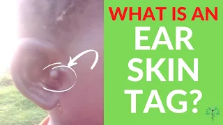 What are Ear Skin Tags? | Dr O'Donovan explains what they are, why they form & how they are treated