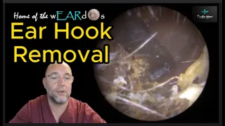 Ear Hook Removal 168 #ear #earwax #earwaxremoval #earcleaning #asmr #asmrearwax #satisfying