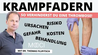 KRAMPFADERN - Ursachen, Gefahr, Behandlung, Risiken, Kosten