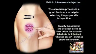 Deltoid Injection For Vaccination - Everything You Need To Know - Dr. Nabil Ebraheim