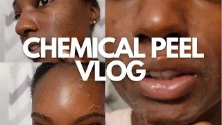 MY FIRST CHEMICAL PEEL | ACNE PRONE