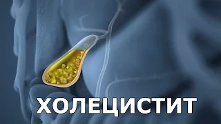 Холецистит