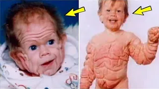 The child was born with Shar Pei syndrome, this is what happened to him 30 years later!