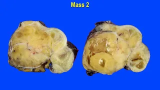 Series of neurogenic tumors: Nine cases of malignant peripheral nerve sheath tumor (MPNST)