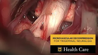 Microvascular Decompression Surgery Provides Relief from Trigeminal Neuralgia (Thorkild Norregaard)