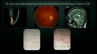 AIOC2018 - IC005 - Topic - Laboratory diagnosis in uveitis – pearls & pitfalls.....