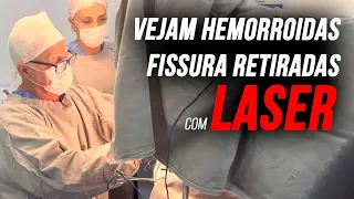 Vejam a fissura,Hemorroida retiradas p/cirurgia c/LASER c/ anestesia local mostradas neste vídeo: