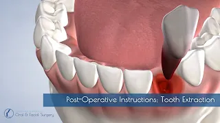 Post-Operative Instructions: Tooth Extraction