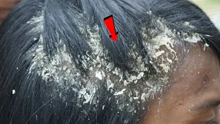 Satisfying Extremely Damaged Dandruff Removal #824