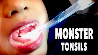 MONSTER TONSILS + Abscess (Tonsillitis) | Dr. Paul