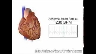 Normal Vs Accelerated Heart Rate