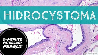 Hidrocystoma: 5-Minute Pathology Pearls
