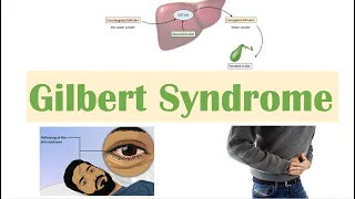 Gilbert Syndrome | Causes (Genetics), Pathogenesis, Signs & Symptoms, Diagnosis, Treatment