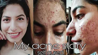 My pimple story Part 1 treatment, and causes | How to reduce pimples and pimple scars | Acne