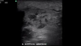 POCUS - Soft Tissue Ultrasound - Abscess