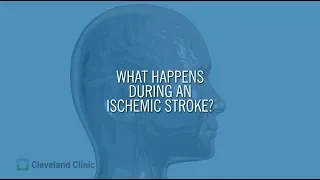 What Happens During an Ischemic Stroke